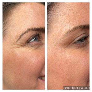 Amanda Kemp Aesthetics Glasgow Wrinkle Reduction Treatment