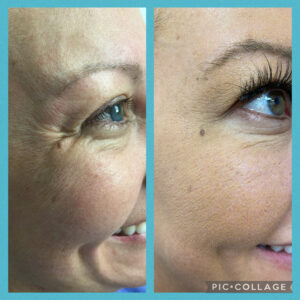 Amanda Kemp Aesthetics Glasgow Wrinkle Reduction Treatment