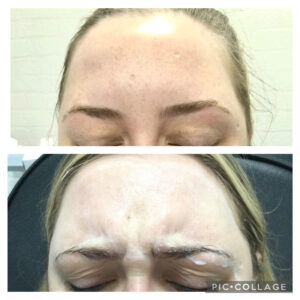 Amanda Kemp Aesthetics Glasgow Wrinkle Reduction Treatment