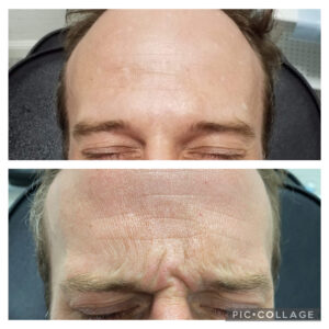 Amanda Kemp Aesthetics Glasgow Wrinkle Reduction Treatment