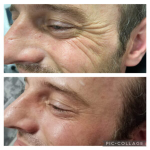 Amanda Kemp Aesthetics Glasgow Wrinkle Reduction Treatment
