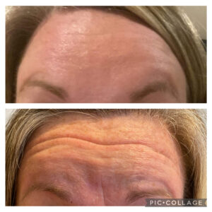 Amanda Kemp Aesthetics Glasgow Wrinkle Reduction Treatment
