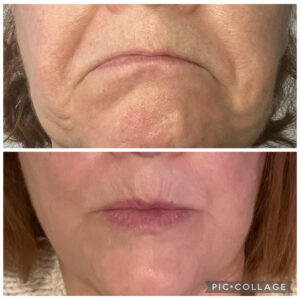 Amanda Kemp Aesthetics Glasgow Wrinkle Reduction Treatment