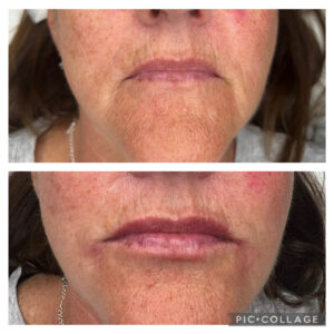 Amanda Kemp Aesthetics Glasgow Wrinkle Dermal Fillers Treatment