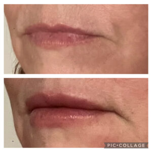 Amanda Kemp Aesthetics Glasgow Wrinkle Dermal Fillers Treatment