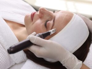 Microneedling Amanda Kemp Aesthetics Glasgow