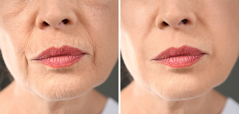 Skin Booster Treatments Amanda Kemp Aesthetics Glasgow
